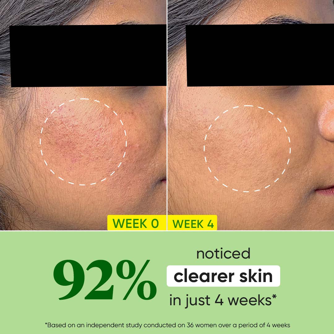 DOT & KEY Cica Calming Oil Free Moisturizer for Acne Prone Skin | 60 g | iBellaa