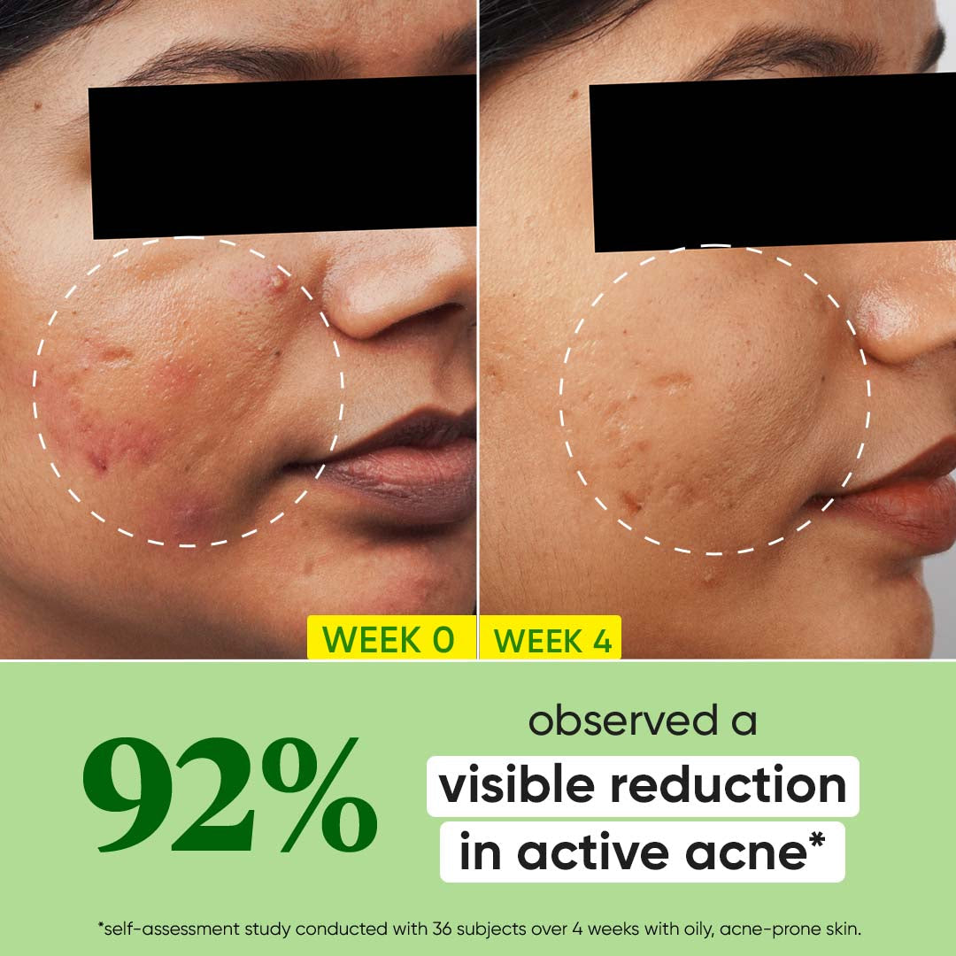 DOT & KEY Cica + 2% Salicylic Acid Serum for Acne & Oil Control | iBellaa